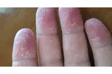 Ellerde Sedef Hastalığı Belirtileri ve Tedavisi