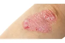 Sedef hastalığı kürü nasıl uygulanır?