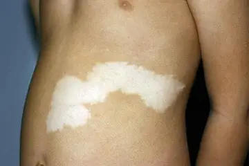 Sedef Hastalığı Çeşitleri Nelerdir?